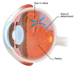 Retinal Detachment via GetEyeSmart.com