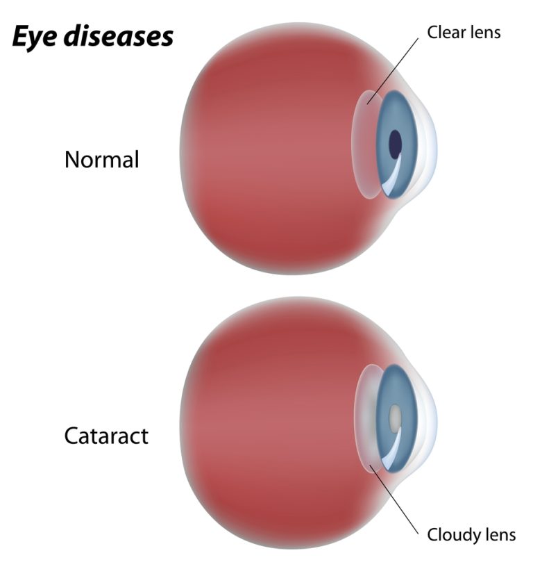 Banish Cataracts to Your Rearview Mirror After Cataract Surgery ...